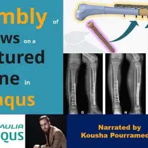 Abaqus assembly of screws on a fractured bone