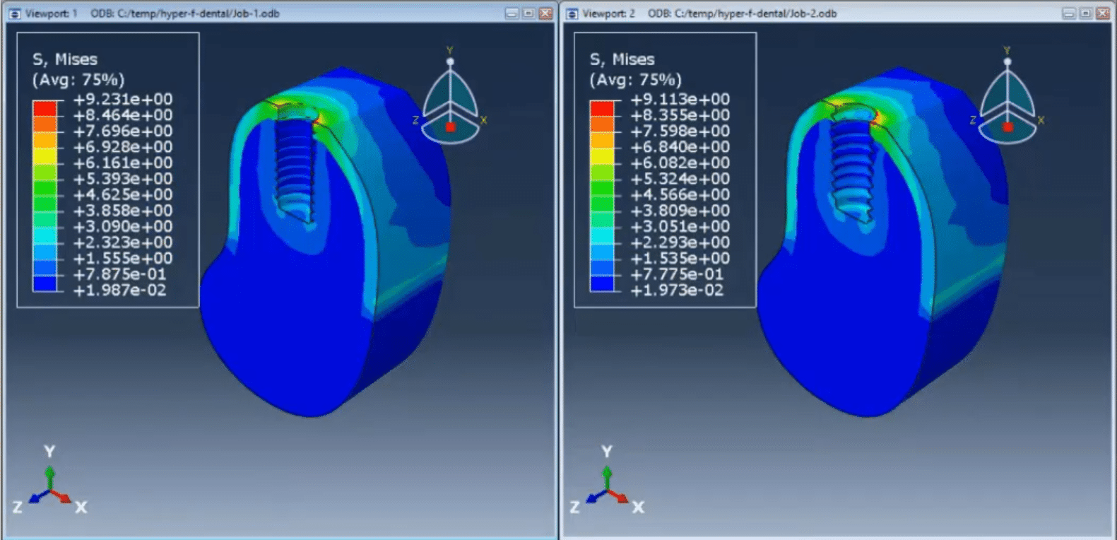 Simulation of Thread Pitch Effects on Stress Distribution in Dental Implants Using Abaqus