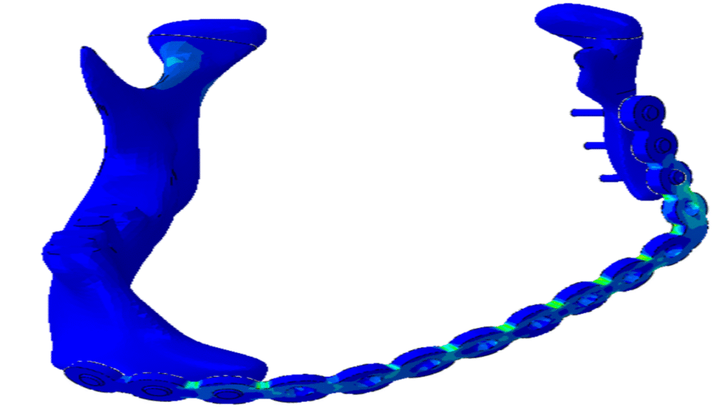 Mandibular plate in Abaqus