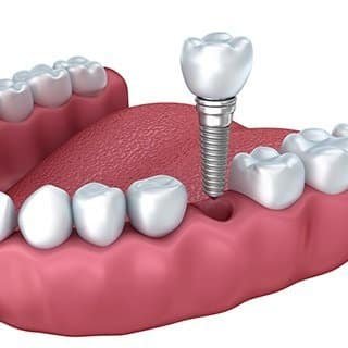 dental3