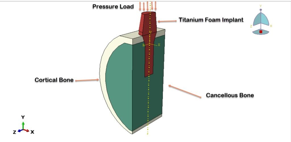 Titanium foam dental implant analysis using Abaqus FEA