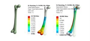 Femur FEA simulation model in ANSYS